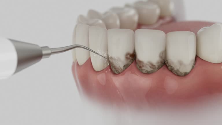 Trusted Dental Veneers service in Beaverton, MI - Dentist Open Now